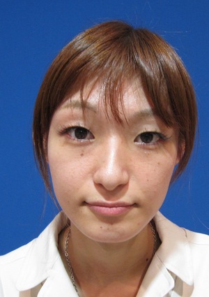 目の下のたるみ、目のくまでお悩みの方、切らずに完璧に解決します。TCB-R法　手術直後　症例写真